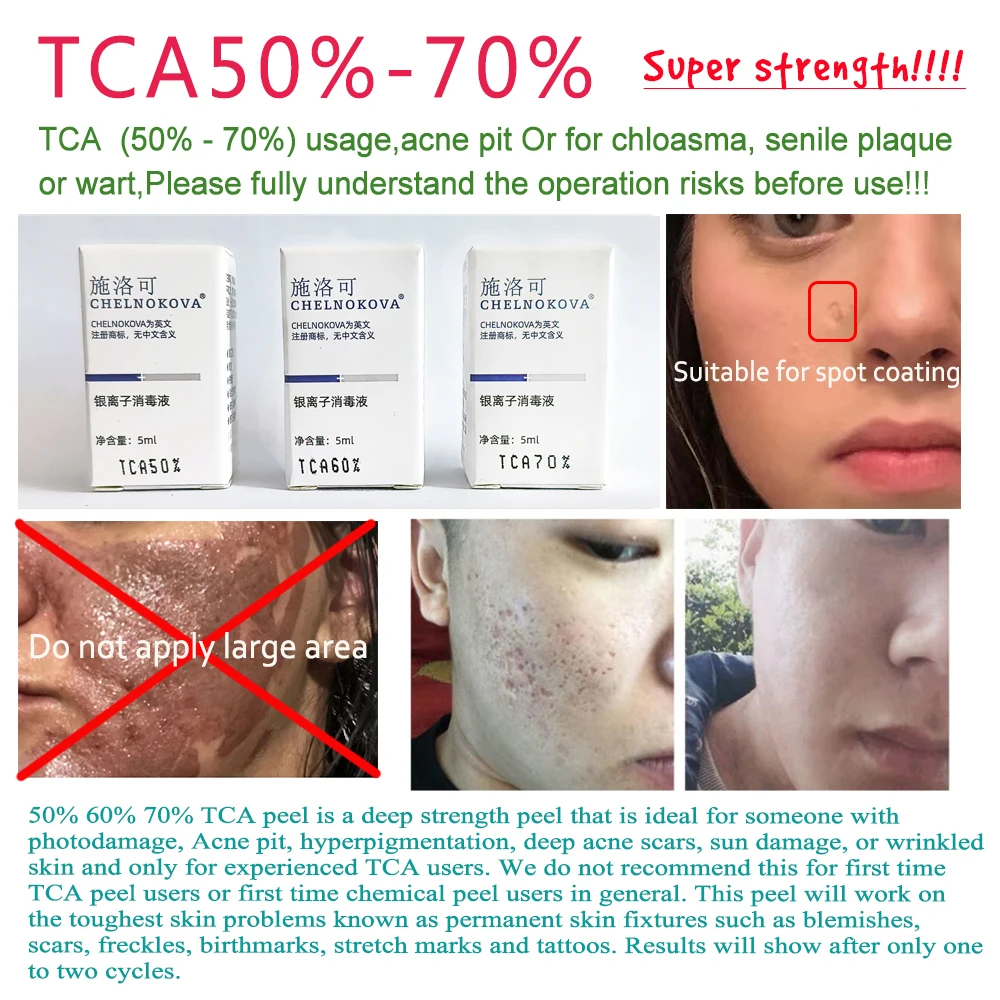 5ml Tca Peel  Skin Peel Kit 50 Removes Tattoos Age Spots Scars Stretch  Marks 2 Free Shipping  Body Care Sets  Kits  AliExpress