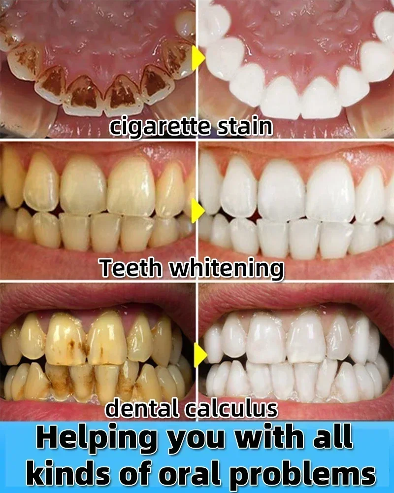 Dental Calculus Remover Teeth Whitening Spray Toothpaste Cleaning Oral Hygiene Removal Halitosis Plaque Stains Fresh Breath Care teeth whitening product,dental calculus remover,teeth health product