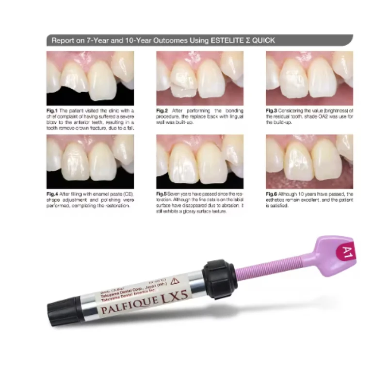 1PCS Dental Materials Tokuyama LX5 Composite Resin A1/A2/A3