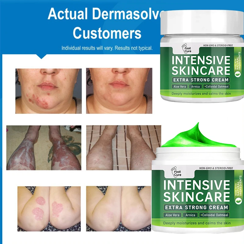 Natural Plant Extract Psoriasis Dermatitis Eczematoid Eczema Ointment Anti-Itch Chinese Herb Medical Skin Care Cream 15/30/50g