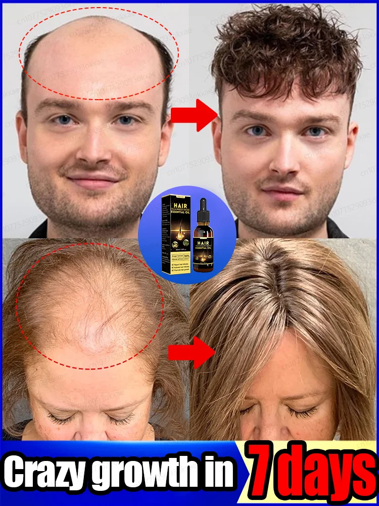 Hair Treatment Oil Hair Treatment Scalp Treatment Rapid hair growth serum treating alopecia areata seborrheic alopecia hereditary alopecia etc.