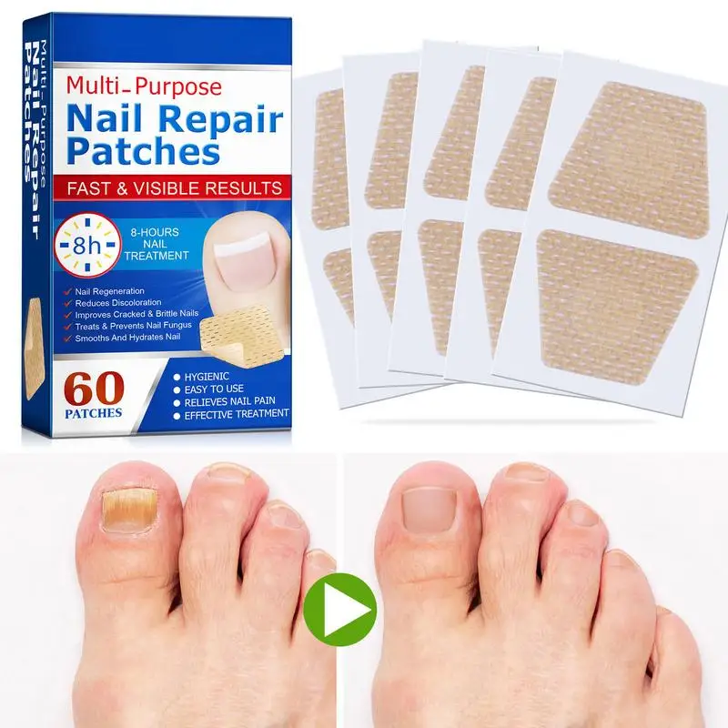 60pcs/set Nail Repair Patches Non Irritating Nail Ingrowning Toenail Corrector Stickers Helps With Cracked Nails 3