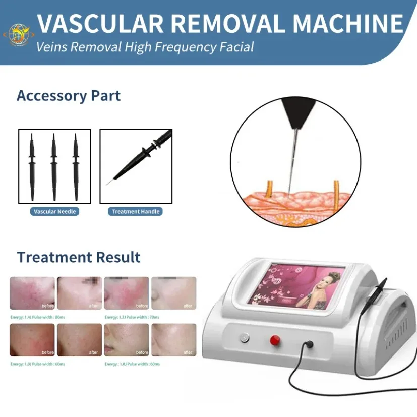 

R-F Spider Vein Removal Blood Vessel Vein Removal Vascular Machine Fiber Coupled High Frequency Beauty Equipment