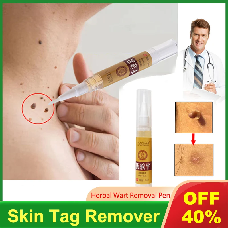 

Skin Tag Remover Pen Wart Removal Liquid Against Mole Warts Remove Tool Papillomas Corn Chinese Herbal Treatment Plaster fast