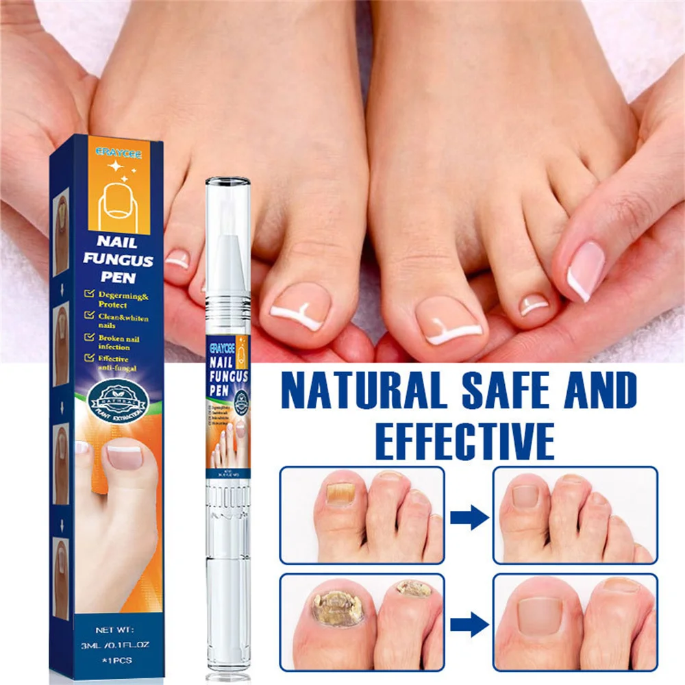 1Pcs Painless Fungal Nail Treatment Pen Onychomycosis Paronychia Anti Fungal Treatment Painless Nail Repair Pen Grey