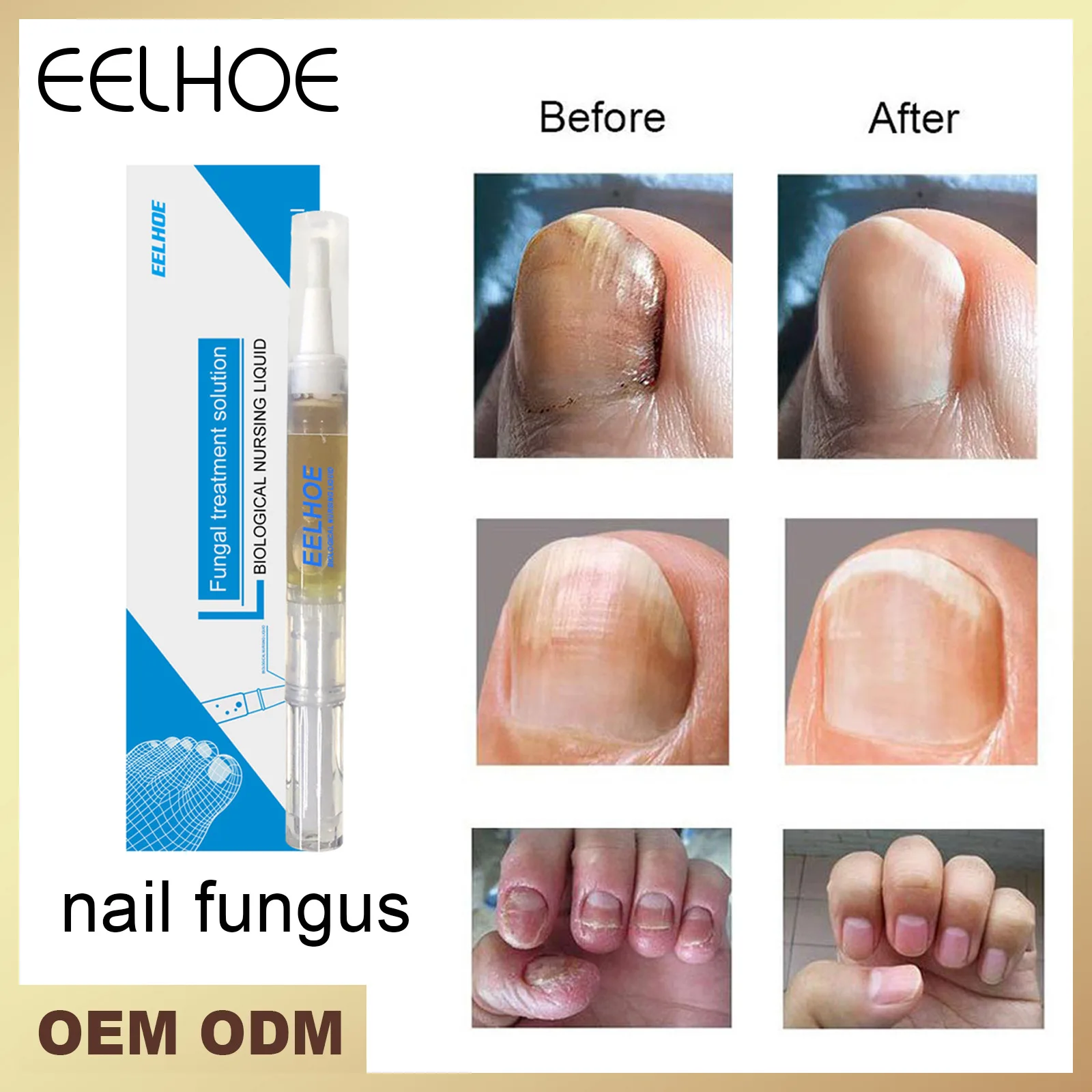 Fungal Nail Pen Effective Onychomycosis Paronychia Fungus Infection