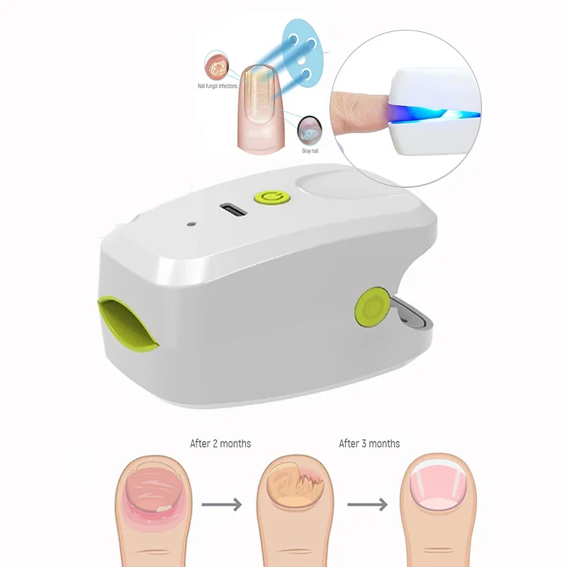 905NM Laser Nail Therapy Device Painless Nail Fungus Treatments Foot