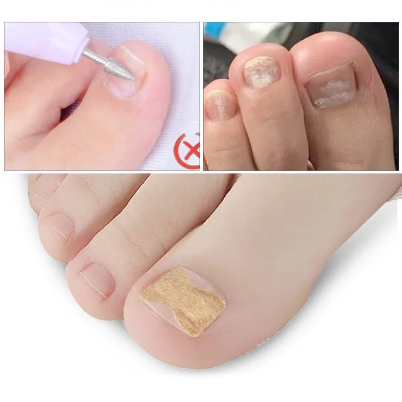 Ingrown toenail correction tool Toe corrector Foot pedicure tool Foot care patches Nail problem solving Ingrown Toenail Corrector Stickers Paronychia Treatment Pedicure Toe Nail Care Corrector Patch Correction Stickers 10-50Pcs
