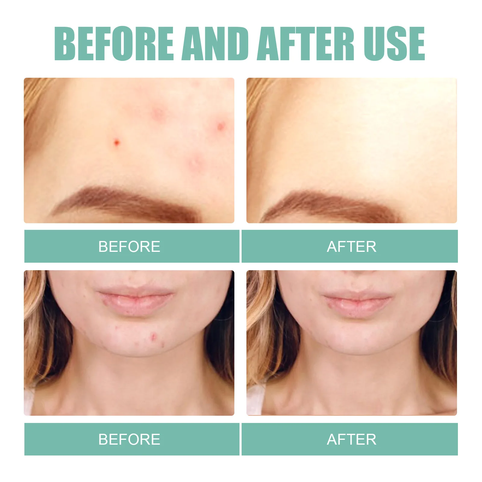 Hydrocolloid Acne Pimple Patches for Face Skin Blemish Treatment