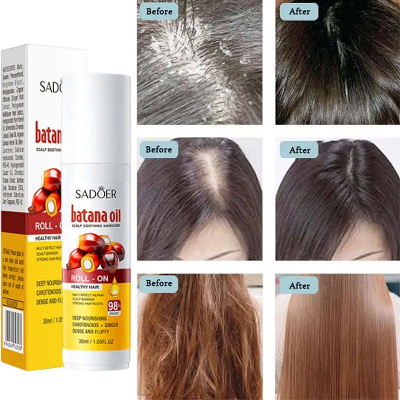 Hair Scalp Treatment Essence Anti Dandruff Itching Oil Control Anti Loss Scalp Cleaning Repair Serum Beauty Hair Care Products