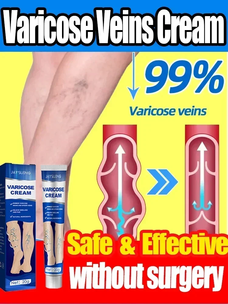 Varicose Vein Ointment Effective Relief Vasculitis Spider Legs Pain Treatment Care Essential