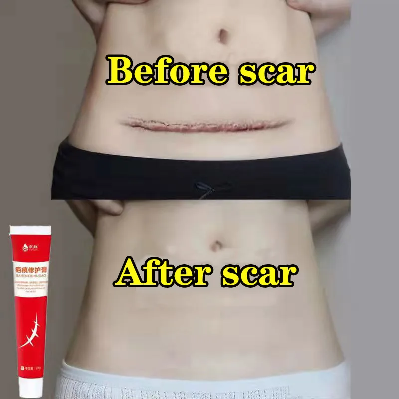 

Acne Surgical Stretch Marks Removal Scar Cream Pimples Face Gel Child Acne Smoothening Whitening Body Skin Care Pigmentation