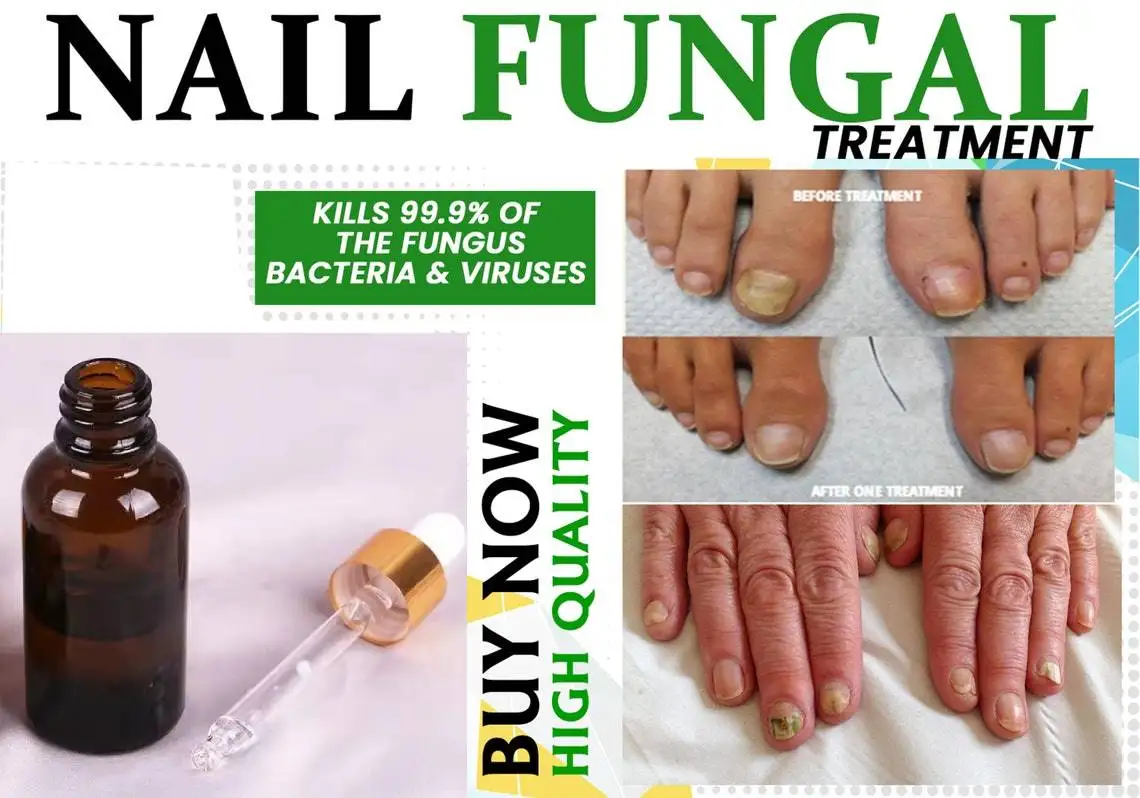 

Anti Fungal Treatment Fungus Effective Finger Toe Nail Repair Liquid Solution