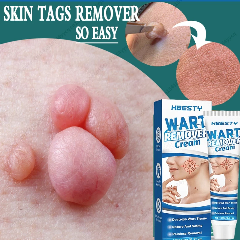 

Skin Wart Spot Tag Remover Cream Painless Mole Dark Spot Warts Remover Serum Freckle Face Wart Treatment Removal Essential Oil
