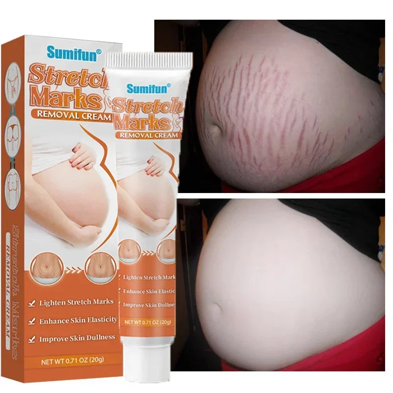 

Removes Stretch Mark Cream Pregnant Women Repair Anti-Aging Anti-Winkles Cream Increase Skin Elasticity Smooth Firm Skin Care