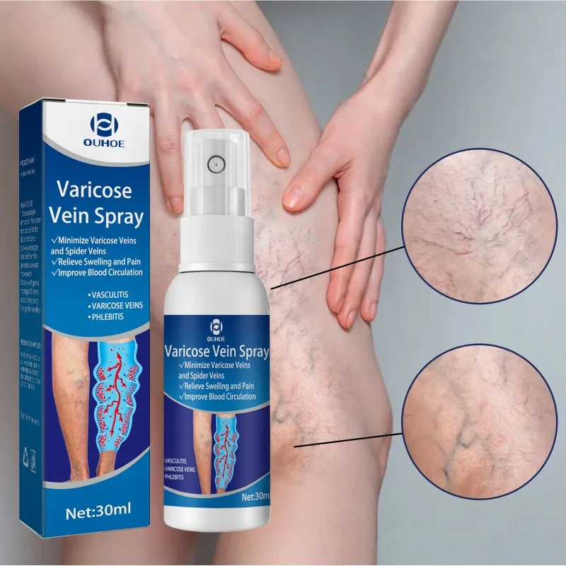 Body Cream 30ml Varicose Vein Spray Vasculitis Phlebitis Relief Cream Spider Legs Treatment Smoothing Blood Vessel Redness Herbal Body Care