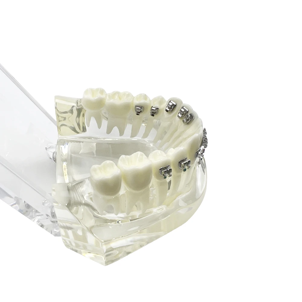 4가지 유형의 브라켓이 있는 치과 교정 모형, 치아 모형, 치과 교육용 학습 시연 모형 (환자 및 학생용)