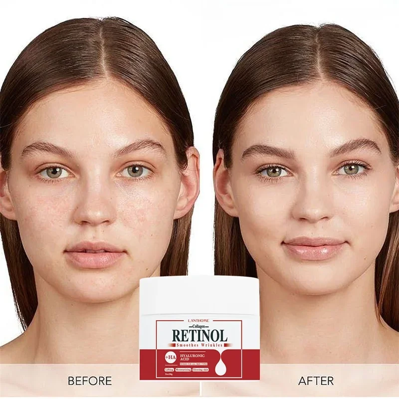 

3 In1 Remove Dark Spots Face Body Whitening Cream Retinol Collagen Hyaluronic Acid Spots Eliminate Melanin Dispel Acne Lighten