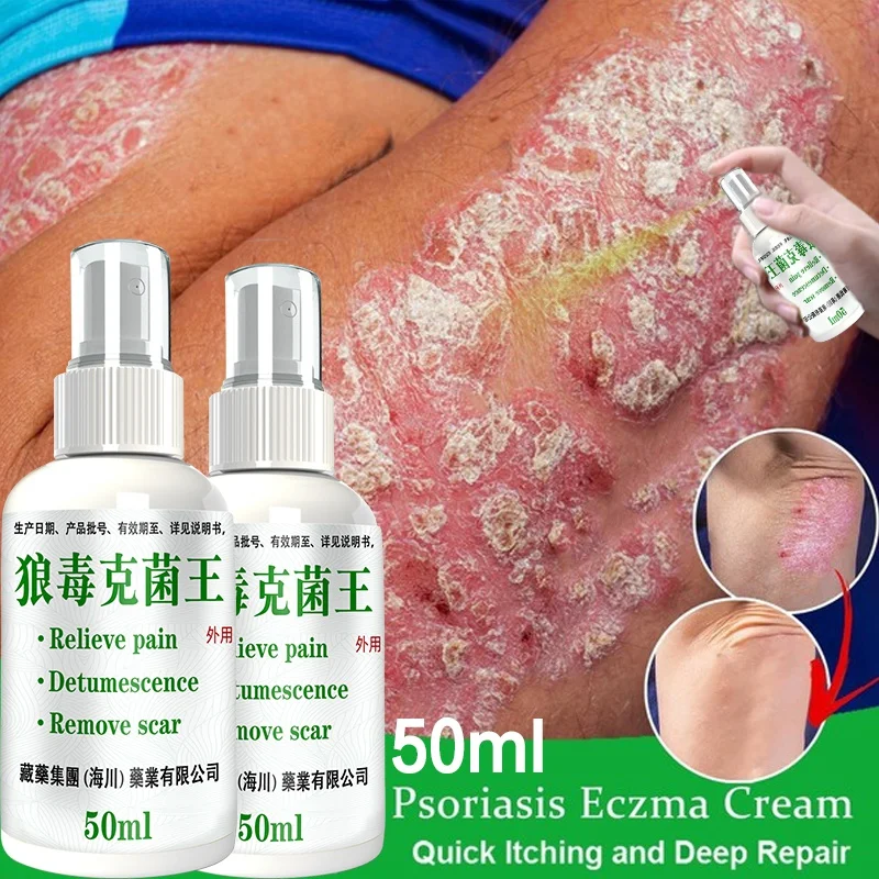 50ml Herbal Eczema Psoriasis Spray Antibacterial Dermatitis Athletes Foot Relieve Itching Irritation Allergies Skin Care