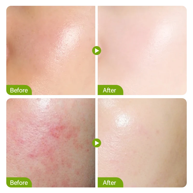Soro do psiquiatra do Poro do ácido láctico, controle de óleo, esfoliante, marcas da acne, reparo, firmando, pele lisa, clareamento, cuidados