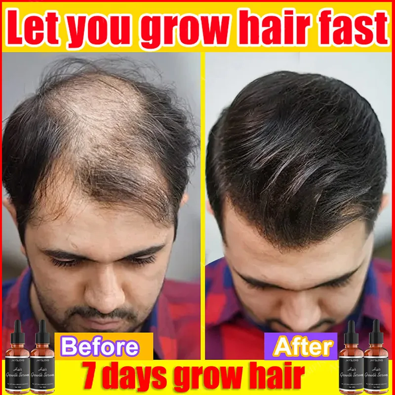 

Hair Growth Oil Fast Hair Growth Effective Treatment for Baldness Hereditary Hair Loss Postpartum Hair Loss Seborrheic Hair Loss