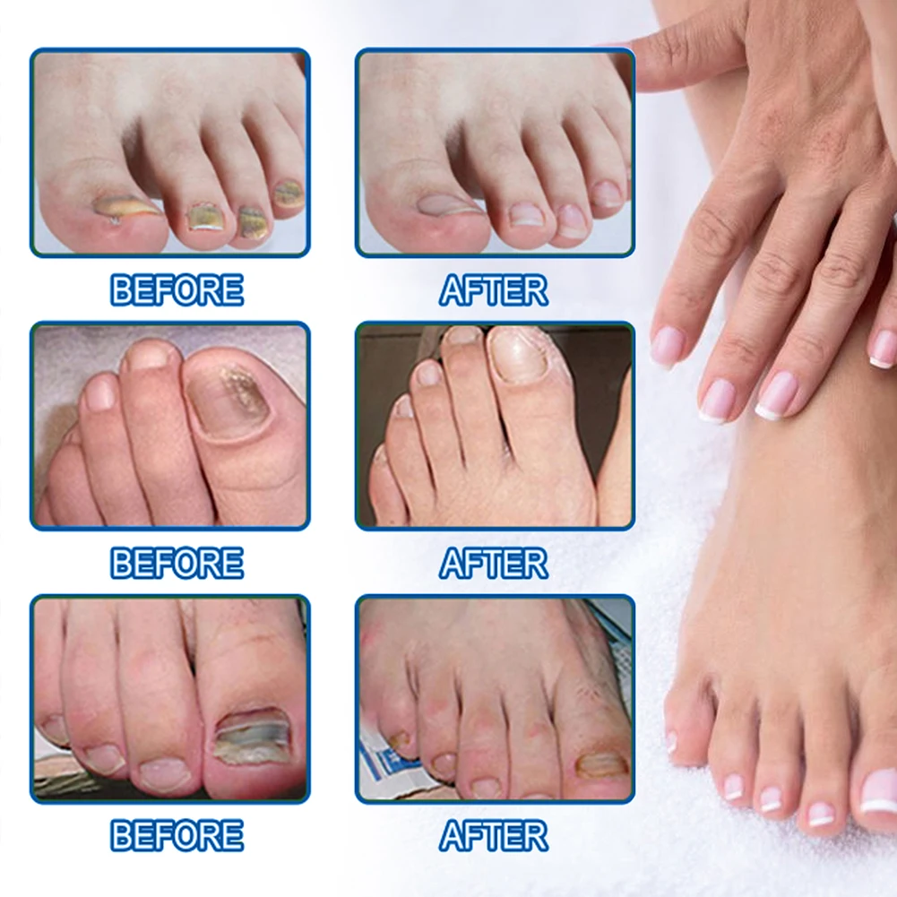 60Pcs Nail Ingrown Correction Stickers Waterproof Nail Repair Patches Nail Repair Stickers for Discolored Or Damaged Nails