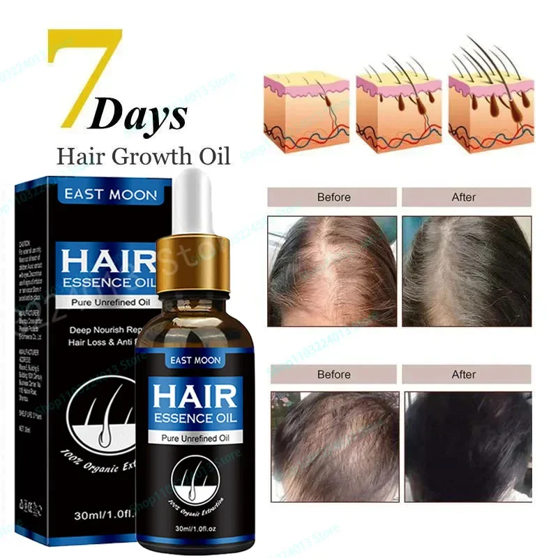 

Unisex Hair Growth Oil Hair Loss Treatment Rapid Hair Growth Effective Baldness Repair Hereditary Postpartum Hair Loss