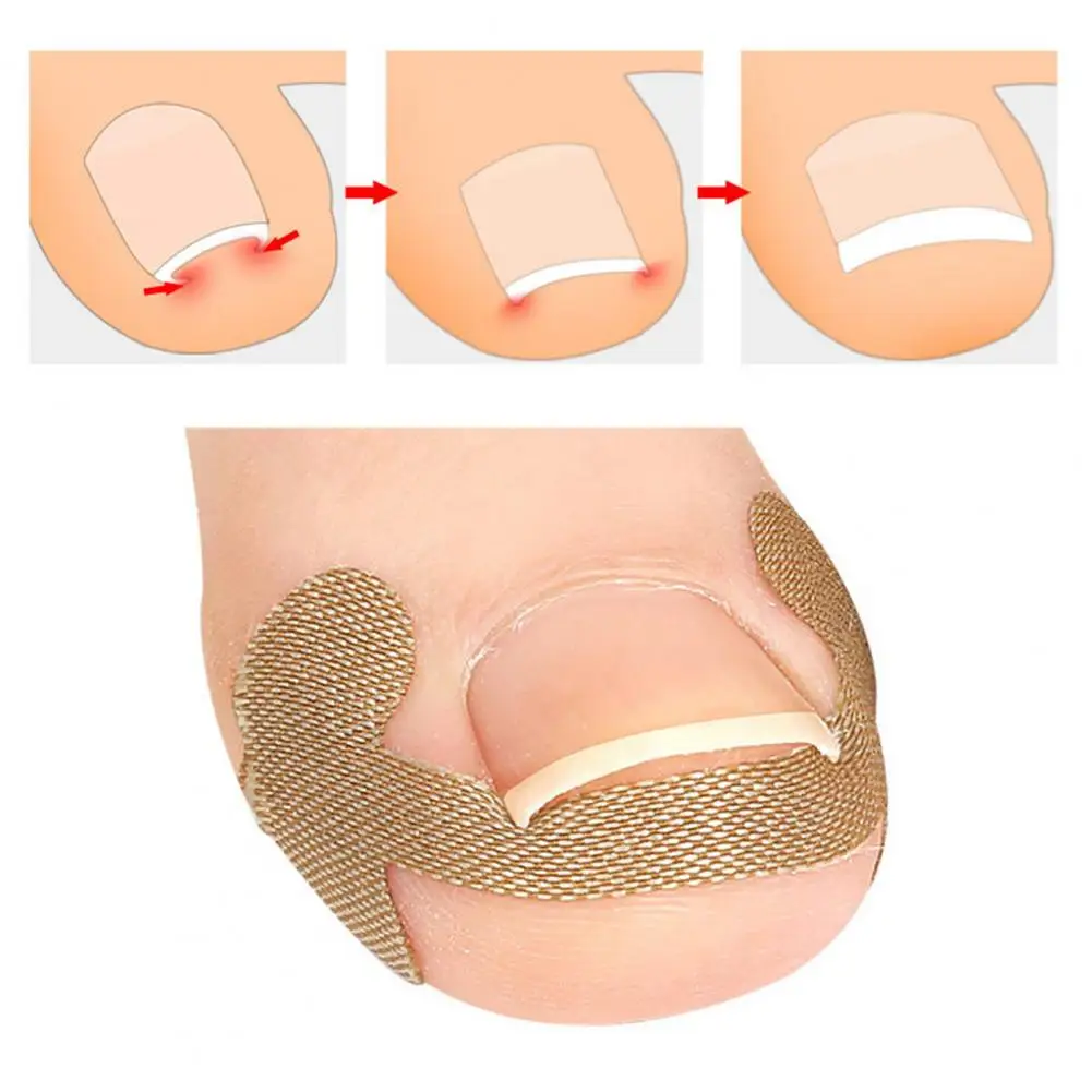 

Nail Corrector Pad 1 Set Premium No Glue Unisex Ingrown Toe Nail Correction Patch Nail Salon