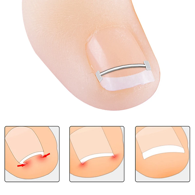 Ingrown Toenail Corrector Tools Pedicure Recover Embed Toe Nail Treatment Professional Ingrown Toenail Straightening Clip Tool