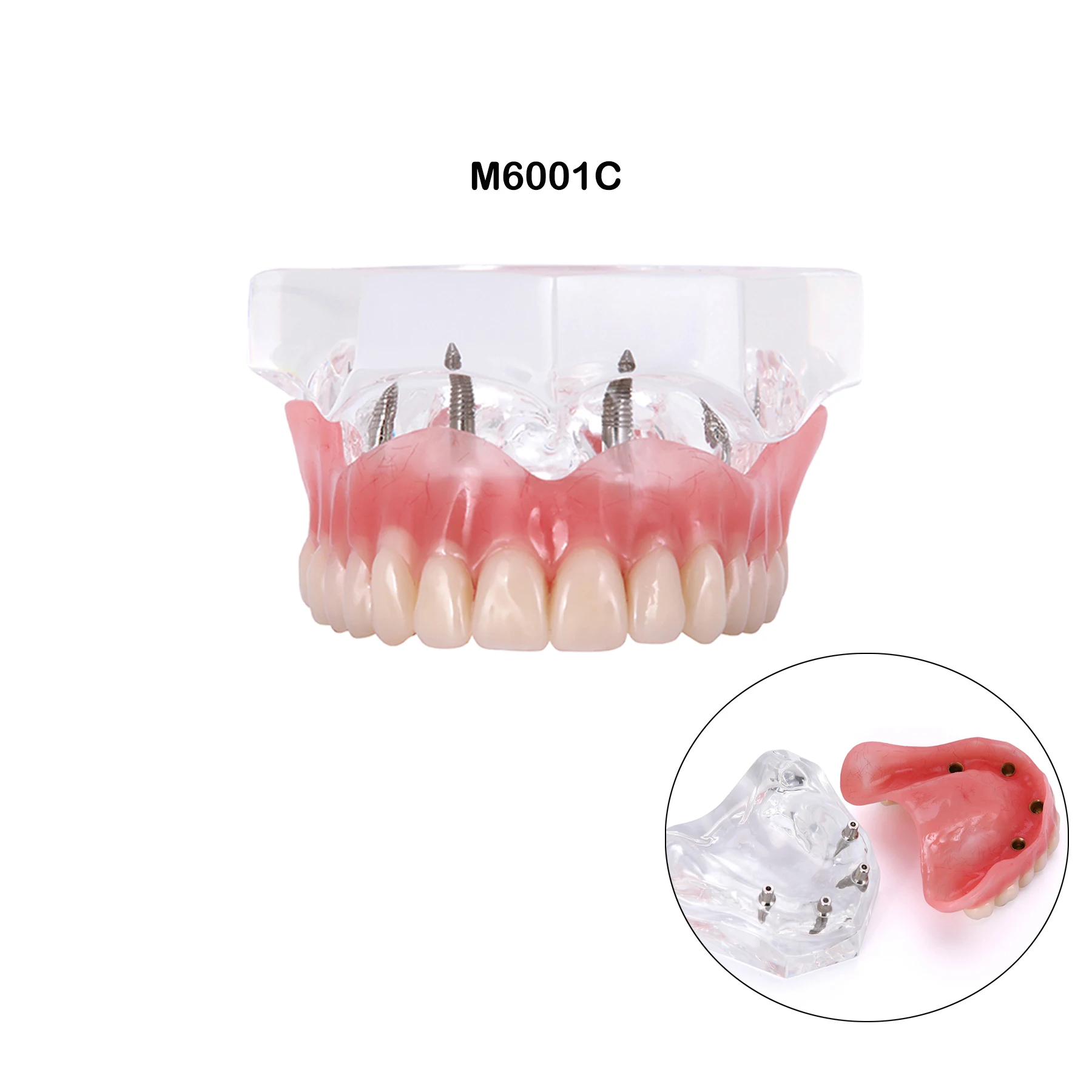 치과용 치아 모형, 임플란트 4개 포함, 오버덴처 복원 모형, 투명 상하악, 치과 의사와 환자 간의 의사소통 시연용