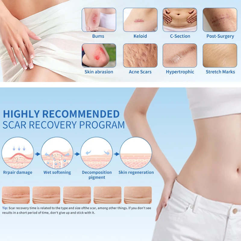 1Pcs Scar Patches Remove Silicone 1mm Gel Treatment Patch Burn Wounds Efficient Surgery Scar Tape Transparent Skin Repair