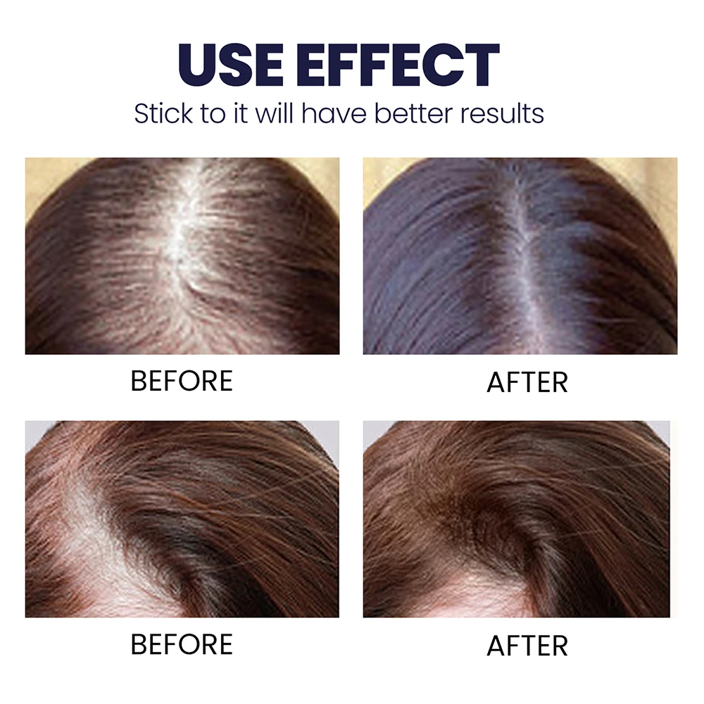 50ml Fast Hair Growth Spray Essential Oils Anti Hair Loss Serum Prevent Baldness Treatment Scalp Dry Damaged Beard Hair Care - Hair Loss Product Series - AliExpress