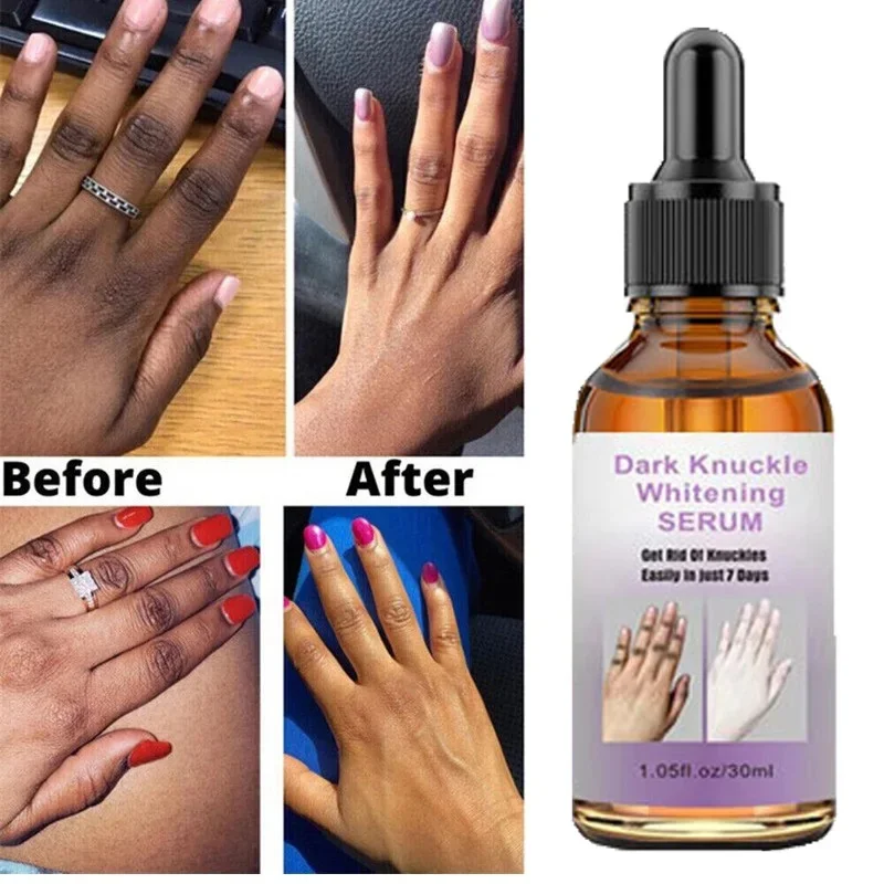 Dark Knuckles Fast Whitening Serum Pigmentation Correctors for Black Skin Hand Knuckle Elbows Knee Intense Stains Remover Serum