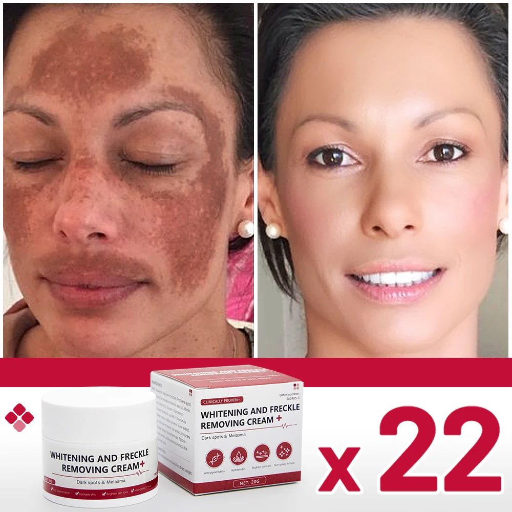 Whitening and anti-freckle cream removes dark spots chloasma freckles age spots lightens pigmentation removes facial spots face cream