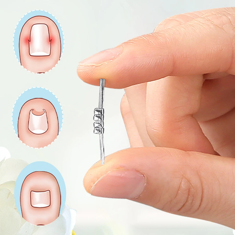 Ingrown Toenail Correction Tool for Foot Care