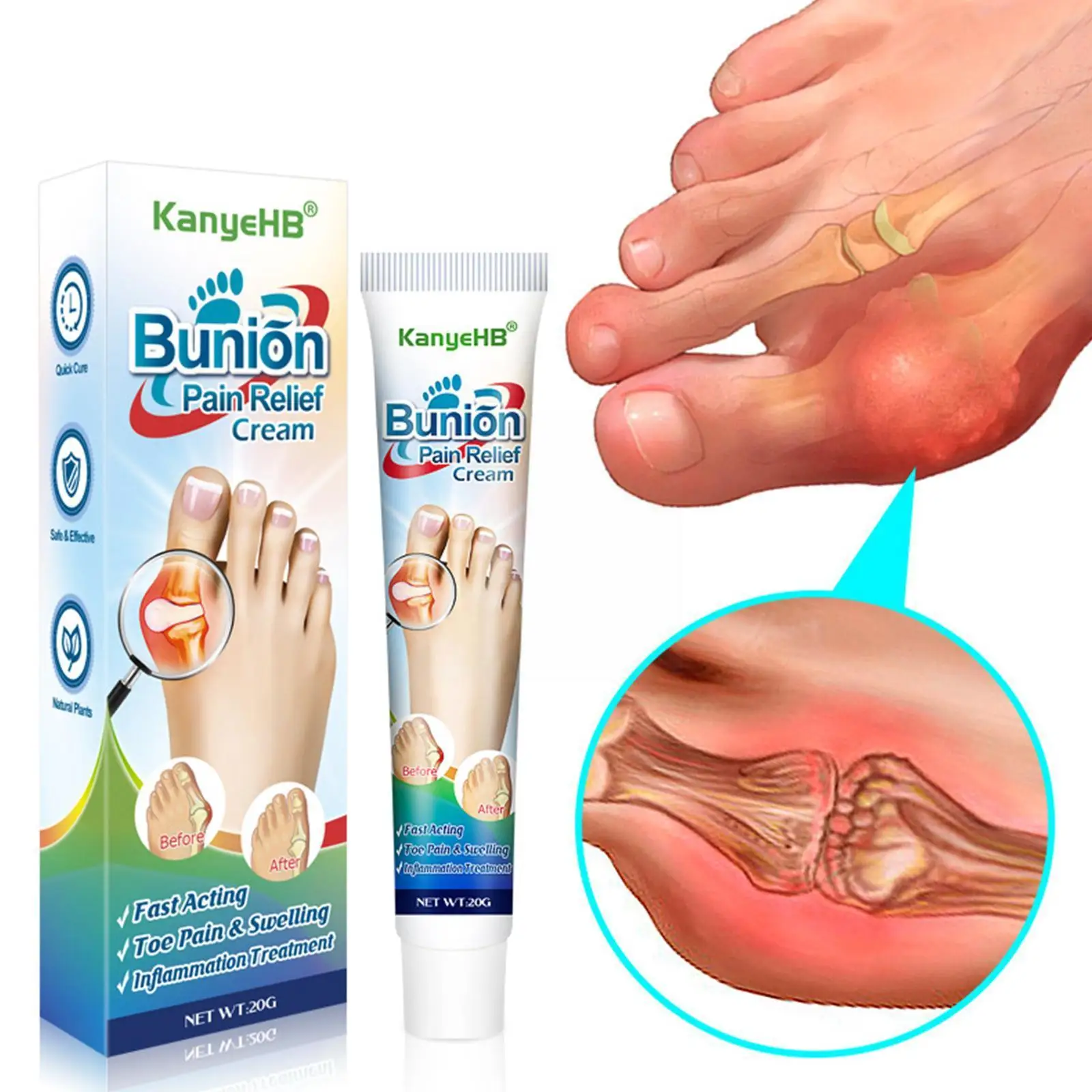 1Pcs Bunion Treatment Ointment Toe Joint Pain Relief Arching Anti infl