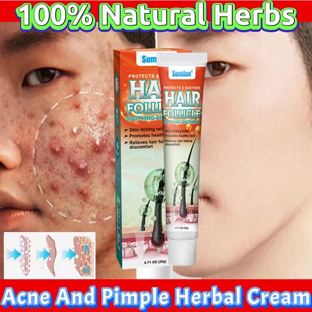 Body Acne Cream – Clear, Smooth & Repair Skin