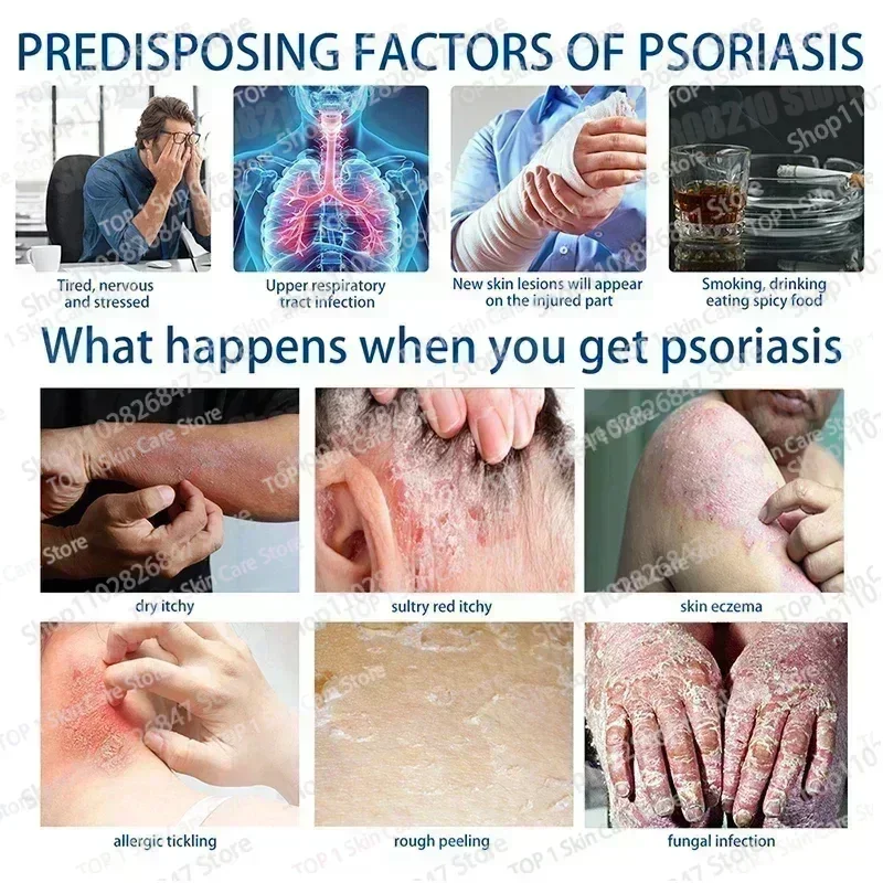 Psoriasis Antibacterial Anti-itch Dermatiti Eczema Urticaria Alergy Skin Beauty Health Body Care