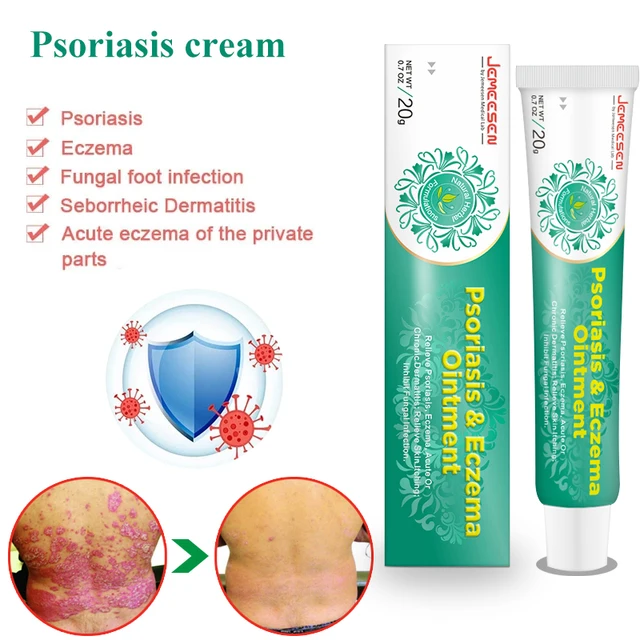 Psoriasis Krém Ekcéma Kenőcs Kezelés Kéz Tinea Pedis Gátolja A Dermatitis Gombaellenes Krémet