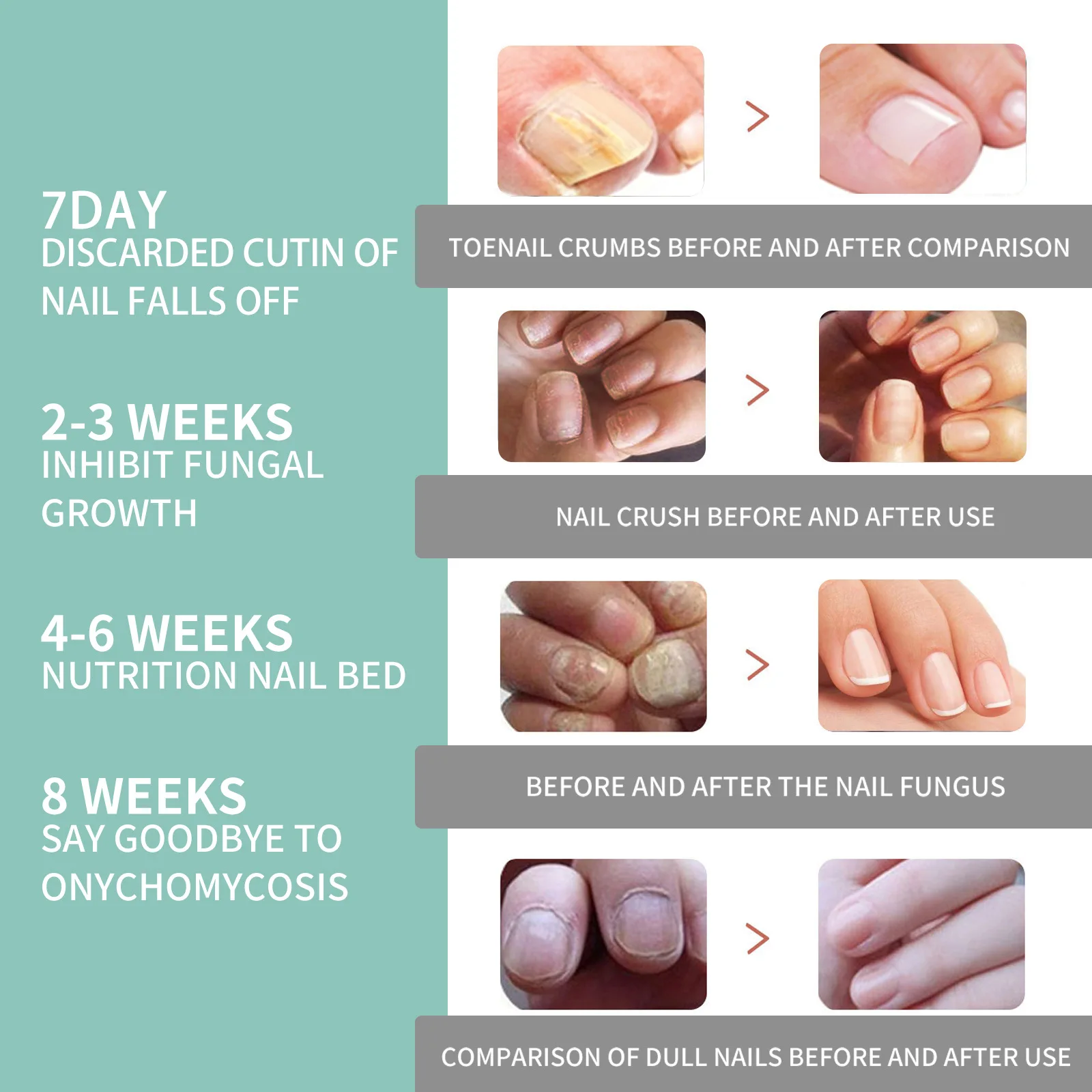 Prevent Nail Fungus with Proper Techniques