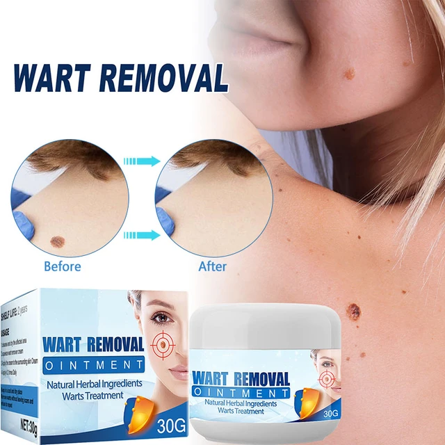 Wart Removal Ointment Body Warts Removal Cream Plantar