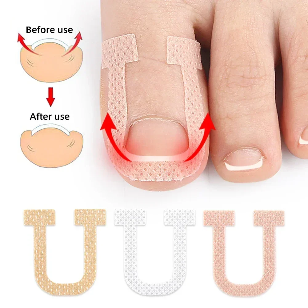 Nail Correction Stickers Ingrown Toenail Corrector Patches Treatment Recover Corrector Pedicure Care Tool 4Pcs/Sheet