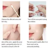 72-720Pcs Invisible Acne Patches Removal Pimple Anti-Acne Hydrocolloid Patches Spots Marks Concealer Repair Sticker Waterproof 3