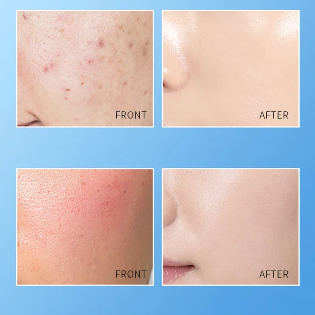 creme reparador de vermelhidão facial para peles sensíveis e rosácea