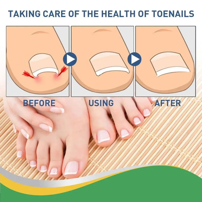 Painless Nail Fungus Therapeutic Instrument Laser Foot Care Whitening Nail Removing Fungus Therapeutic Device u&ntilde;as 발톱무좀 nail fungus remover