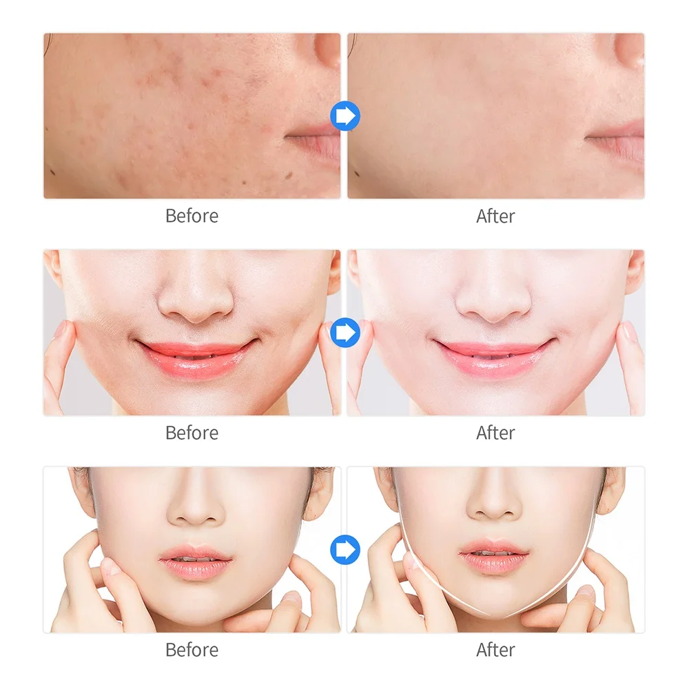 Anti Acne Plasma Therapy Scar Acne Removal Beauty Device Acne Skin Treatment Plasma Facial Skin Rejuvenation Skin Care Machine