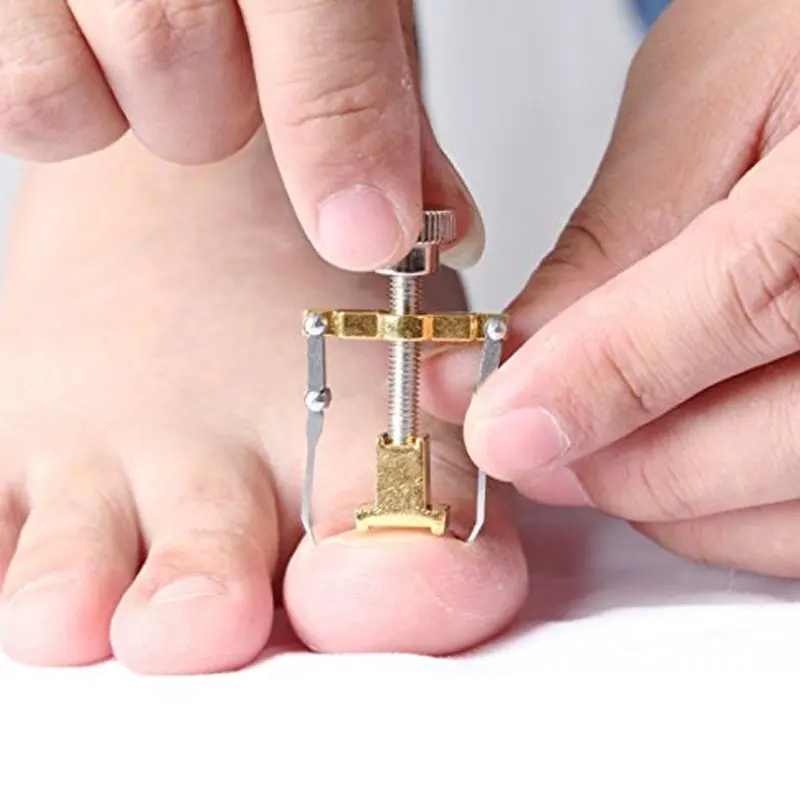 Correction of Paronychia with Toe Nail Correction Bracket for Treatment of Toe and Toe Care with Toe Fixator 3