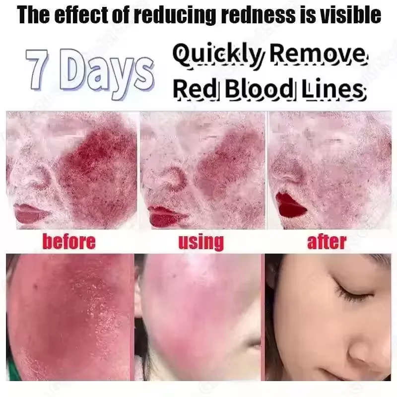 Soothing Facial Redness Repair Mask - Moisturizing & Sensitive Skin Relief Serum