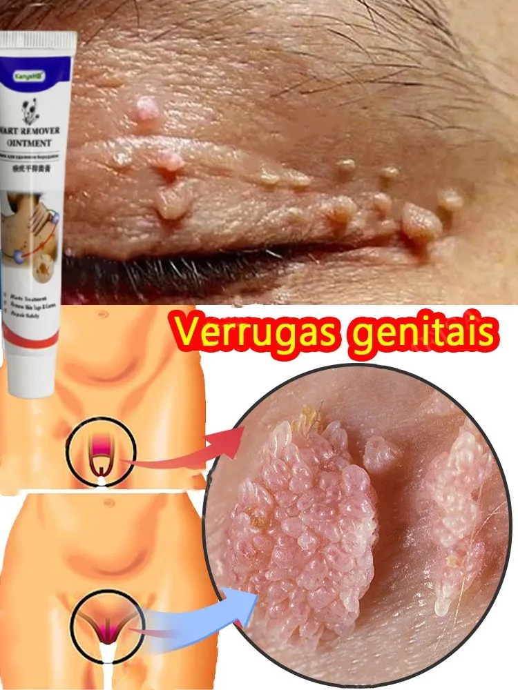 

Multiple PCS Remove Wart Medical Cream Genital Warts Plantar Warts Ommon Warts Flat Wart Skin Tag Wart Remover Herbal Ointment