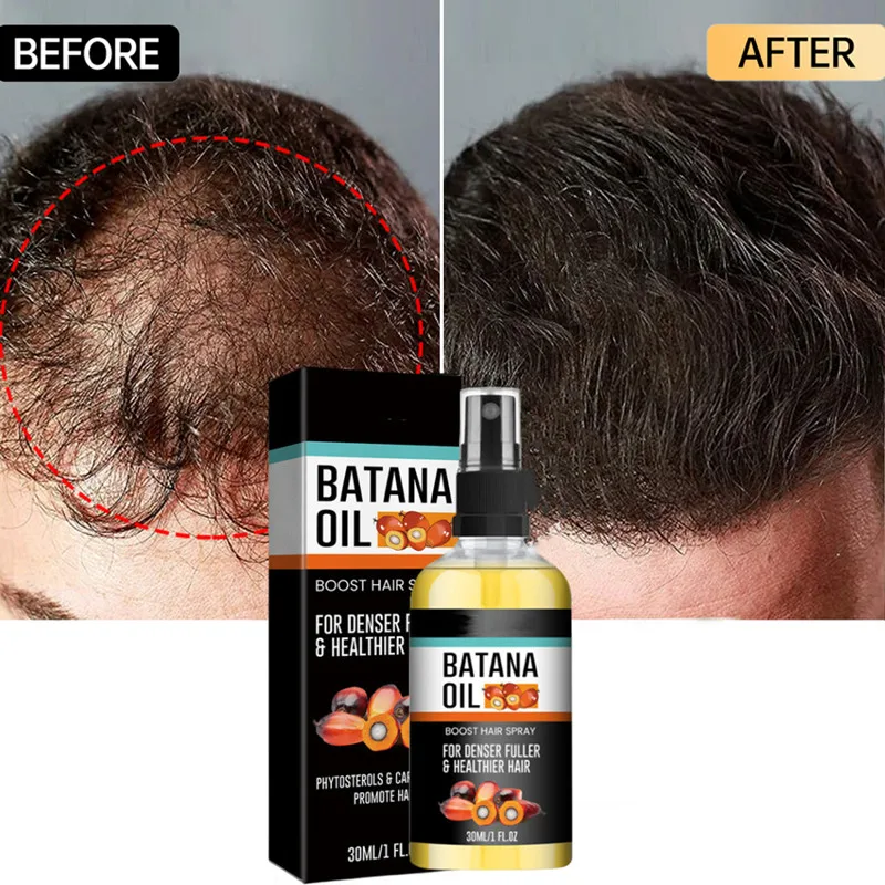 30ML Batana Oil Hair Growth Oil for Men Women Anti Hair Loss Scalp Treatment Serum 7 Day Fast Regrowth Care Growth Products
